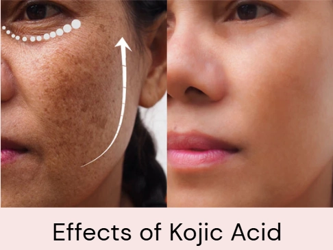 Effect of Kojic Acid