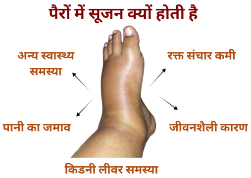 पैरों में सूजन क्यों होती है