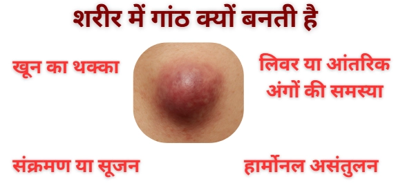 शरीर में गांठ क्यों बनती है
