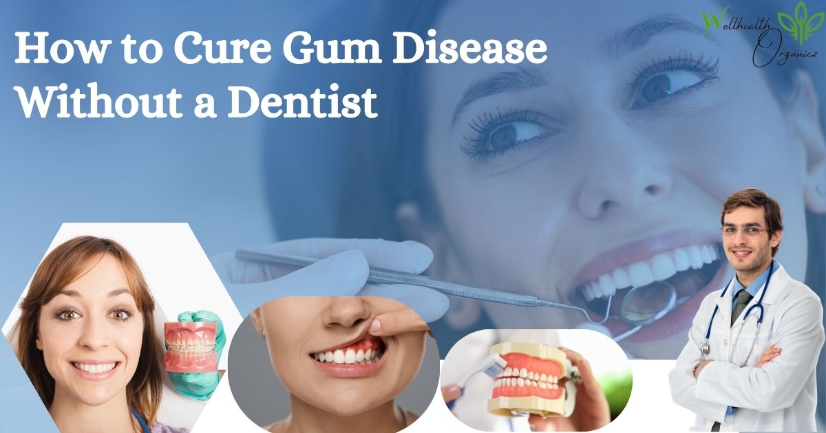 How to Cure Gum Disease Without a Dentist